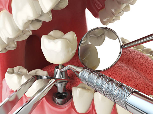 Best Emergency Treatment for Dental Infections or Abscesses in Bronxville, NY